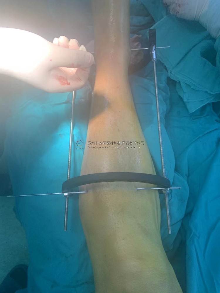 【望京醫院】不開刀治骨折——CO接骨架典型病例分享 【望京醫院】不開刀治骨折——CO接骨架典型病例分享